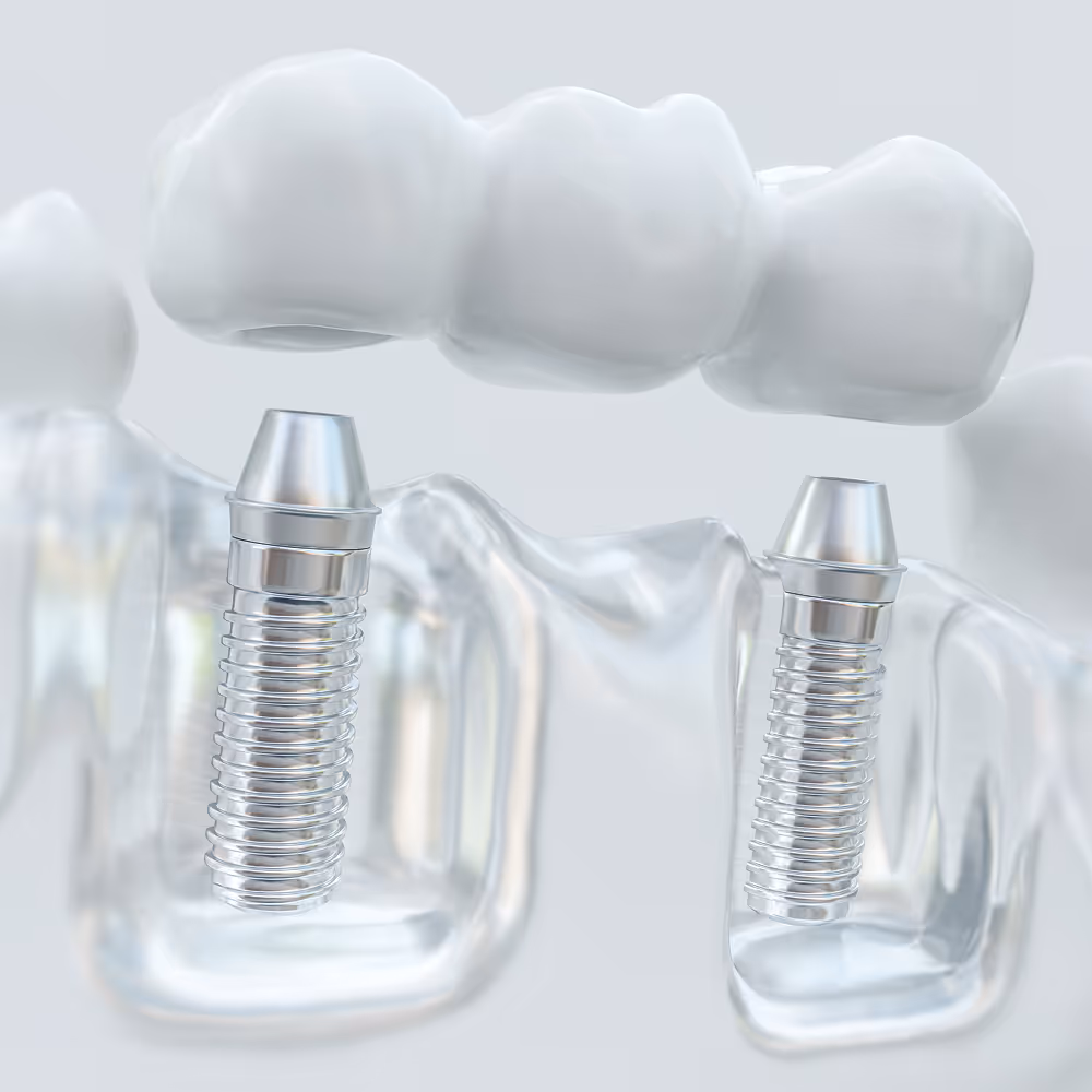 Illustration of dental bridge showing artificial tooth supported by crowns on adjacent teeth