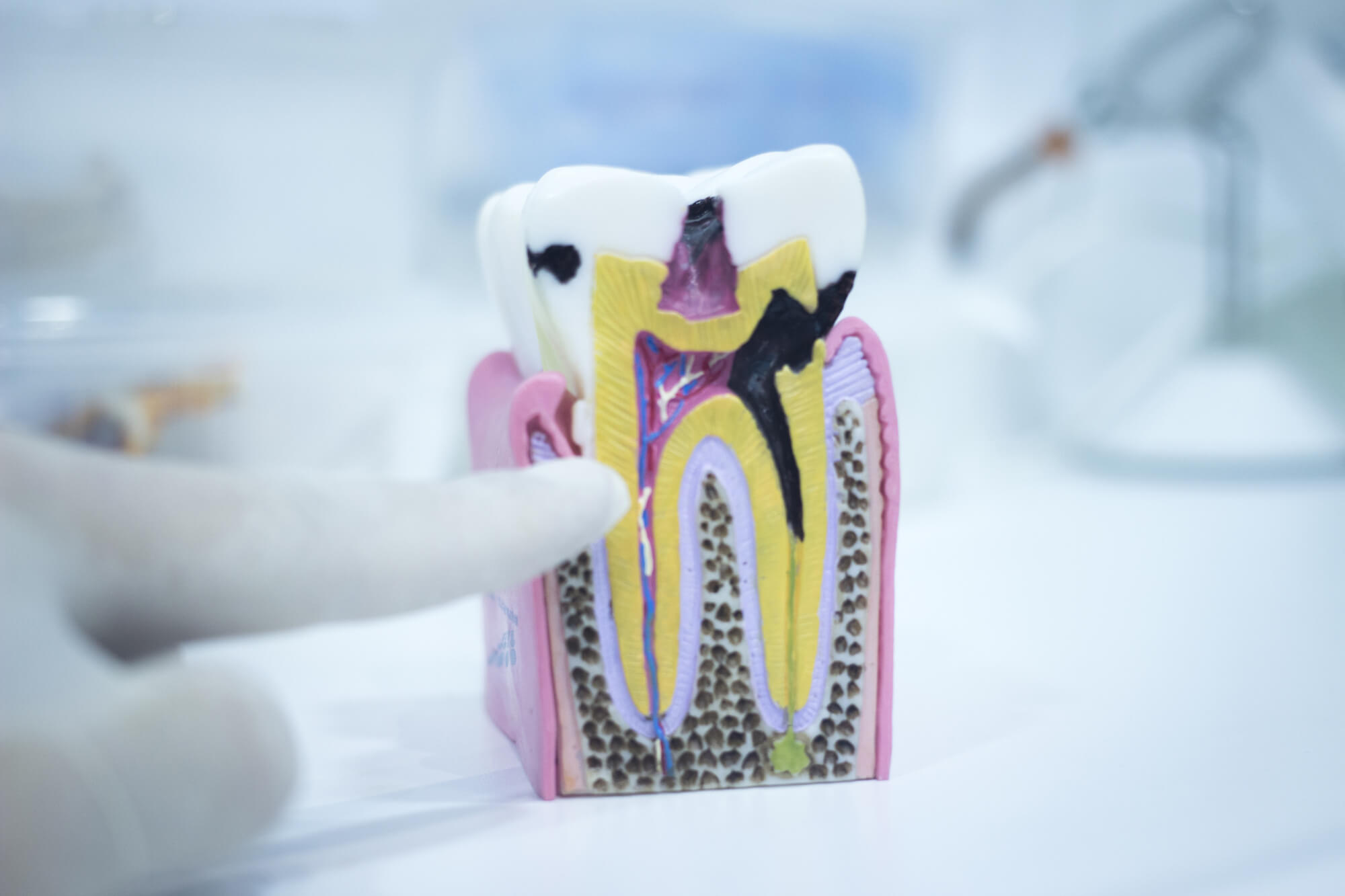 tooth decay model used by the Best Dentists in Coral Gables