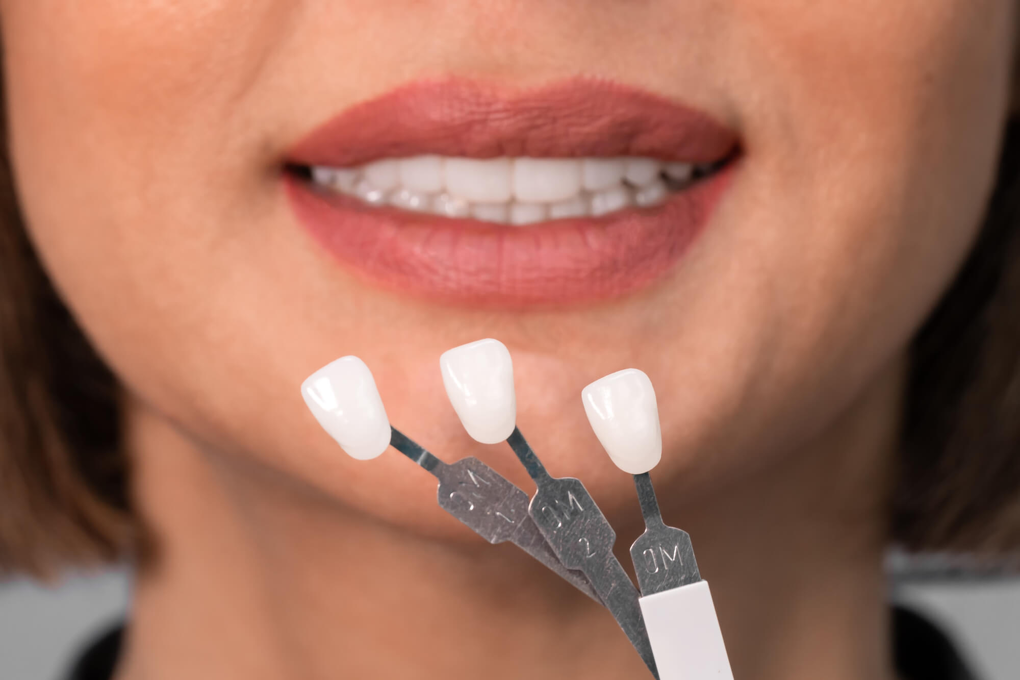 3D Printed Veneers in Coral Gables