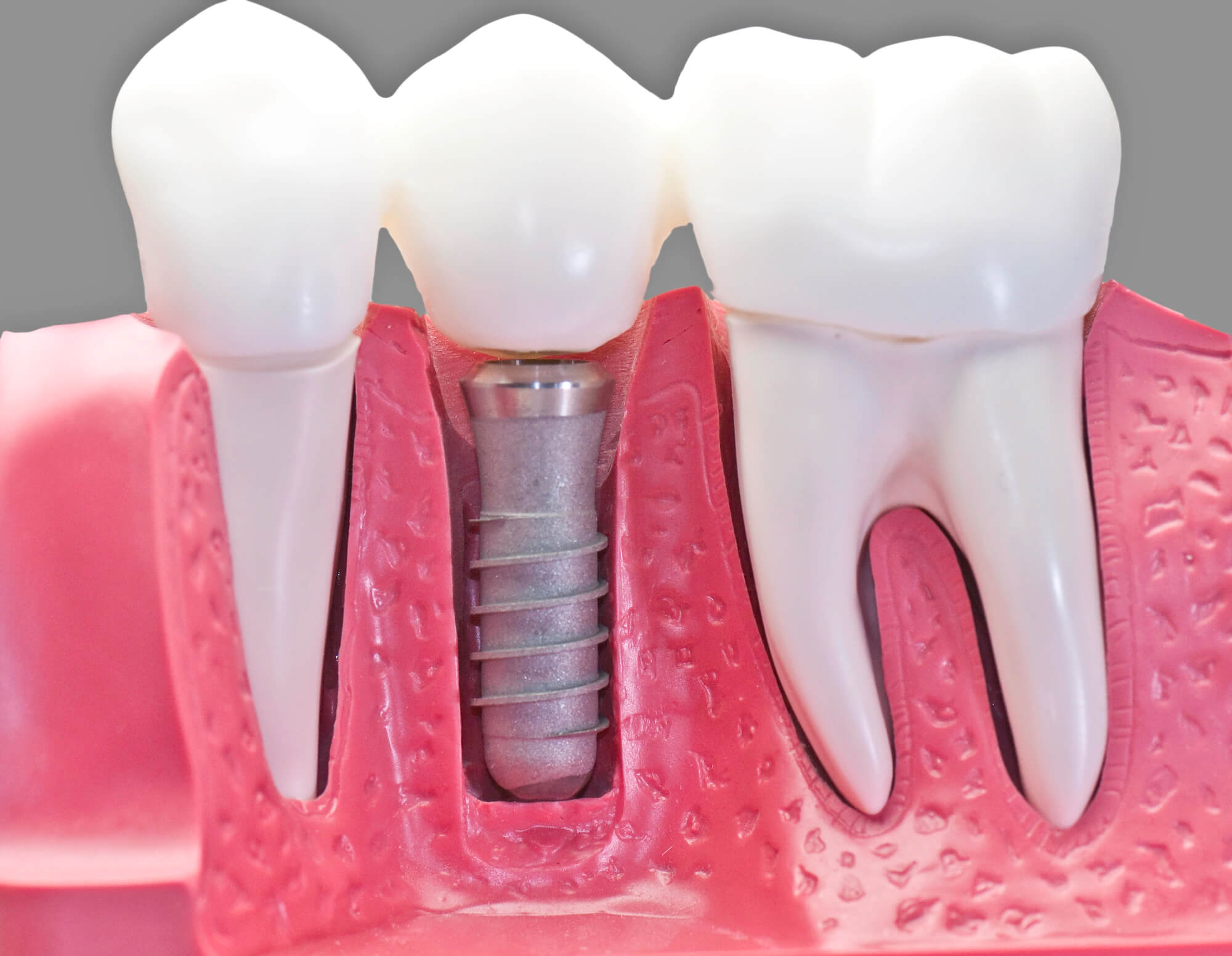Dental Implants Used in a Smile Makeover in Coral Gables