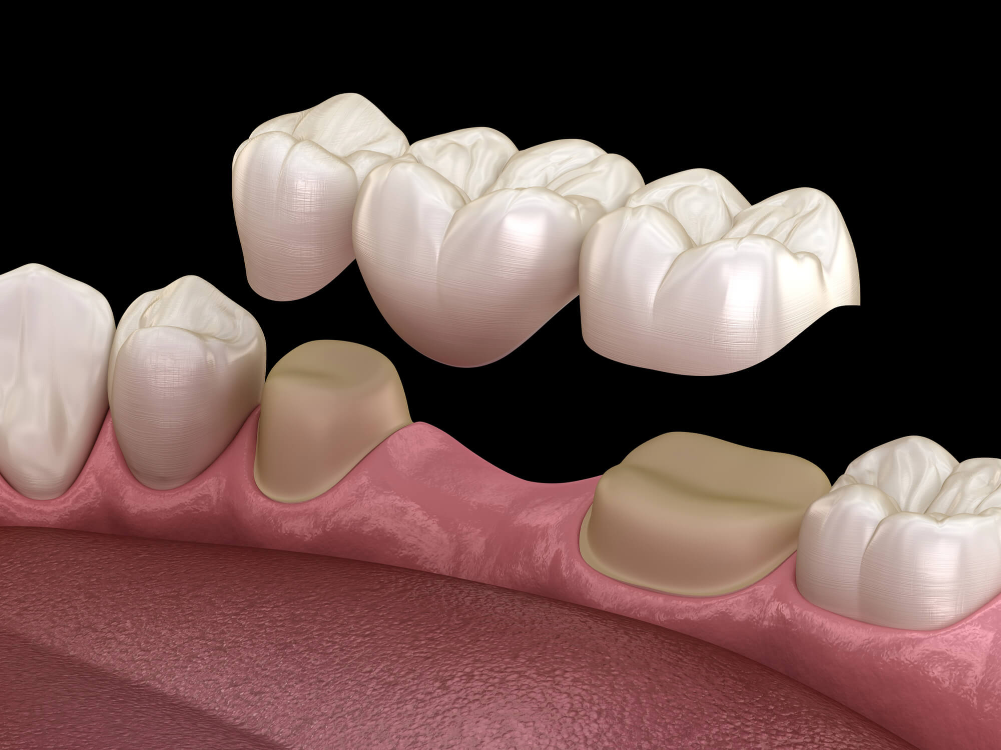 Prosthodontist in Miami Explains Dental Bridge