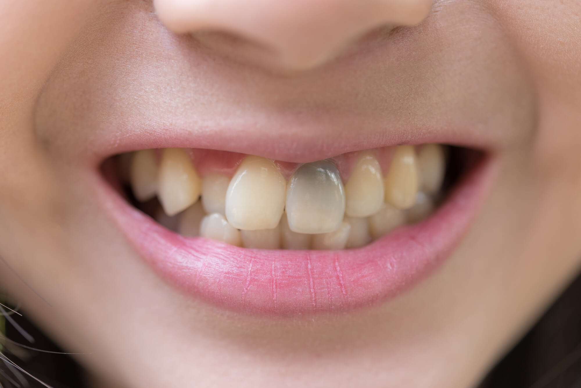 Intrinsic Stain Needing Teeth Whitening in Coral Gables
