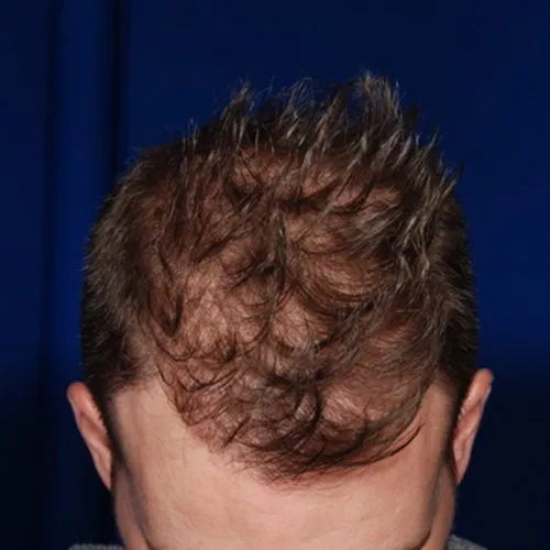 Achieve natural-looking hair restoration with Neograft at Dallas Men’s Health. Safe, effective, and minimally invasive for optimal results.