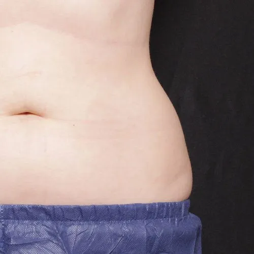 Achieve your ideal shape with Venus Bliss Max™; effective, non-invasive body contouring technology.
