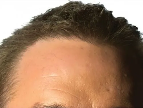 The ARTAS iXi™ hair transplant device is a state-of-the-art robotic system designed to precisely and efficiently harvest and transplant hair follicles, providing a natural and effective hair restoration solution.