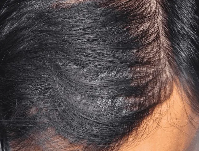 The ARTAS iXi™ hair transplant device is a state-of-the-art robotic system designed to precisely and efficiently harvest and transplant hair follicles, providing a natural and effective hair restoration solution.