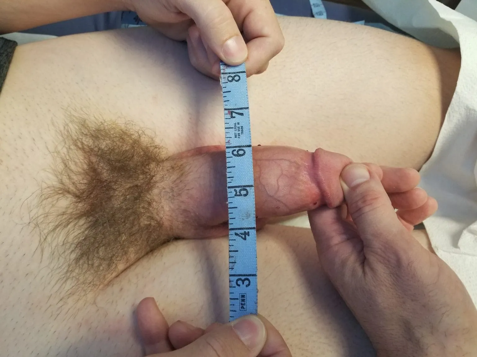 Increase penile girth safely with GirthPro - the innovative UroPlastics technique developed by Dr. Wierschem. Minimal downtime, natural-looking, confidence-boosting results at our award-winning Male Enhancement Center of Excellence.