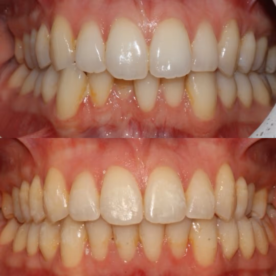 Four close-up images showing before and after dental treatment: upper front teeth and lower teeth with misalignment in before images, corrected alignment and a dental retainer wire in after images.