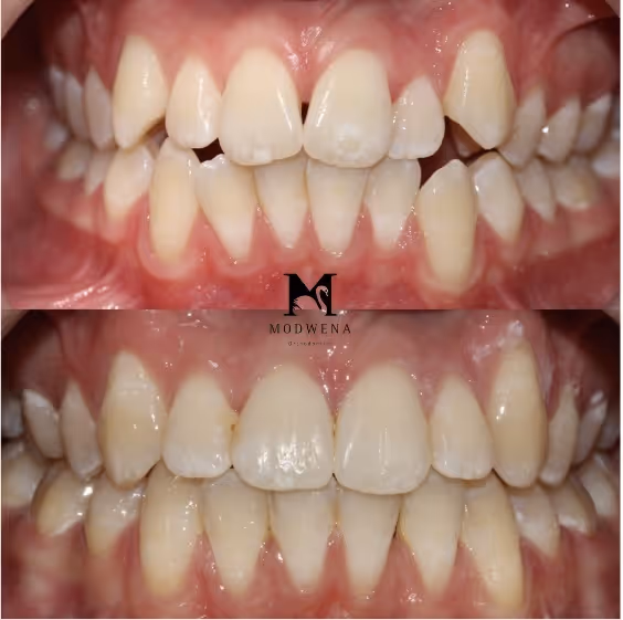Before and after close-up images of teeth showing improved alignment and whitening after dental treatment.