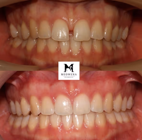 Before and after images showing dental alignment improvement with orthodontic treatment, closing gaps between upper front teeth.