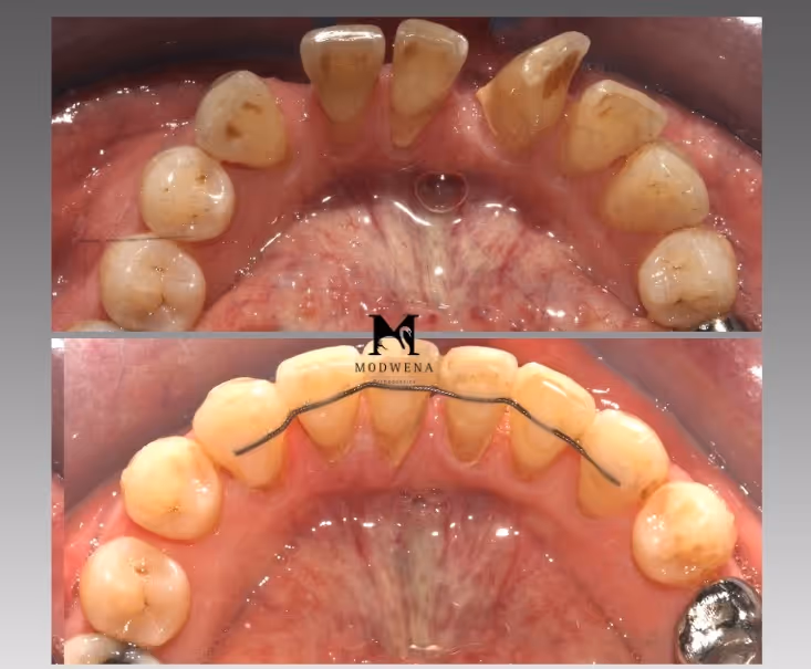 Before and after images of lower teeth showing significant cleaning and whitening, with a fixed retainer wire attached to the back of the teeth in the after image.