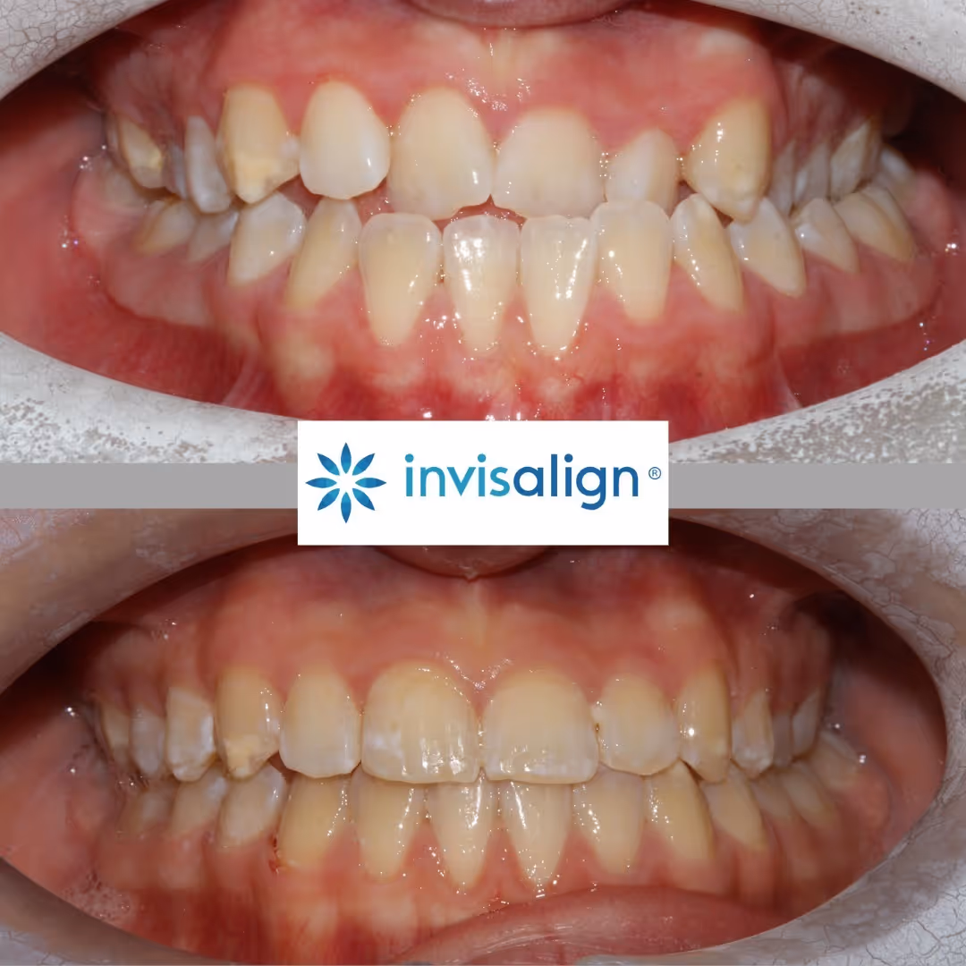 Before and after Invisalign treatment showing misaligned upper and lower teeth corrected to straight and evenly spaced teeth.