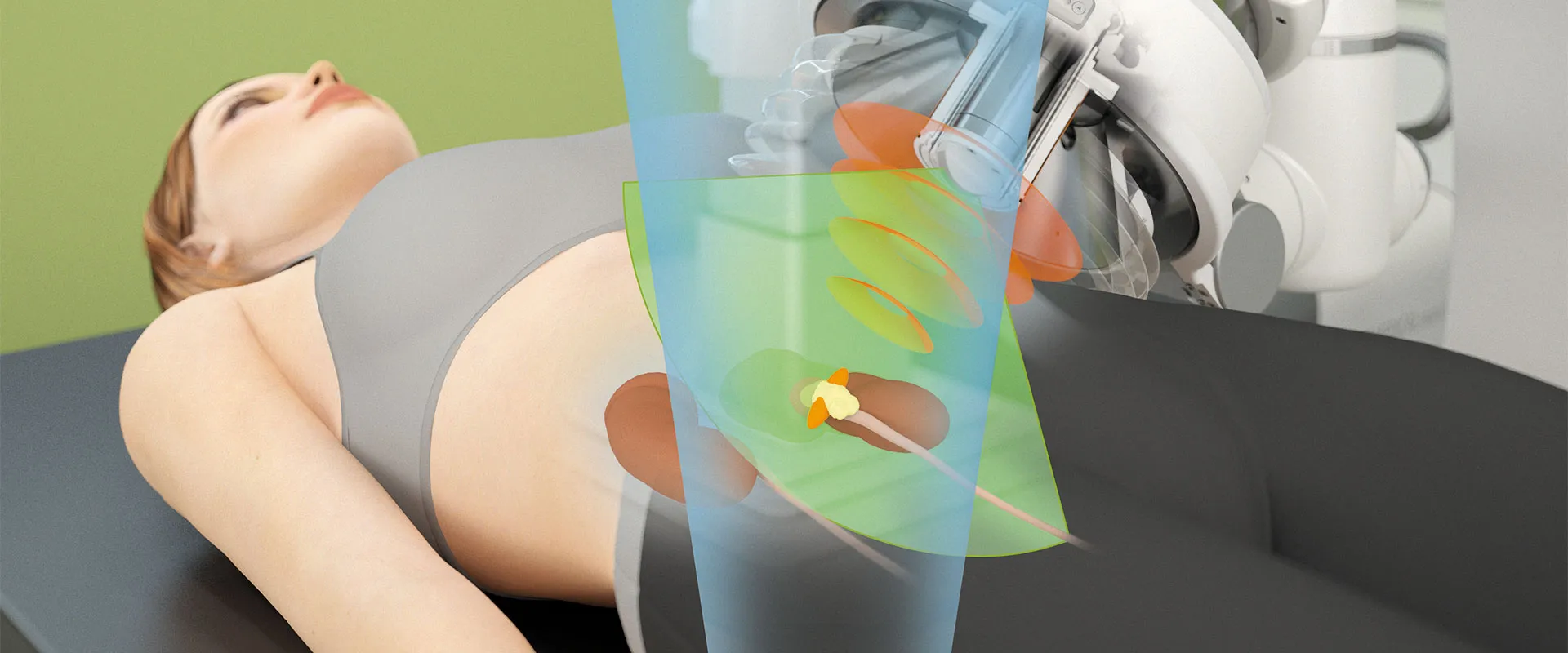 Illustration of a lithotripsy imaging beam targeting a kidney stone inside a patient