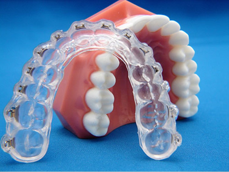 A clear indirect bonding tray fitted over a dental model, holding each braces bracket in its planned position
