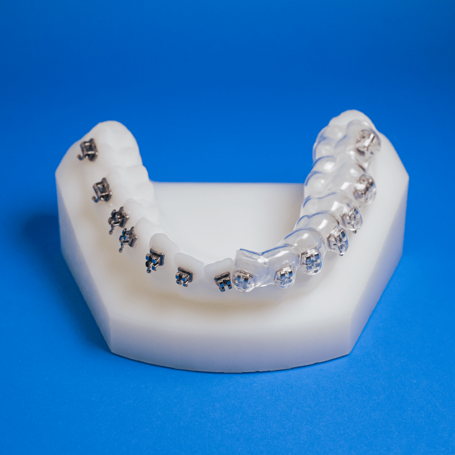 Indirect bonding tray holding orthodontic brackets before placement at Ogden Orthodontics