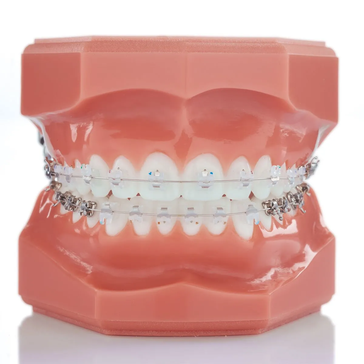 Clear ceramic braces on a dental model, brackets blending with the tooth color