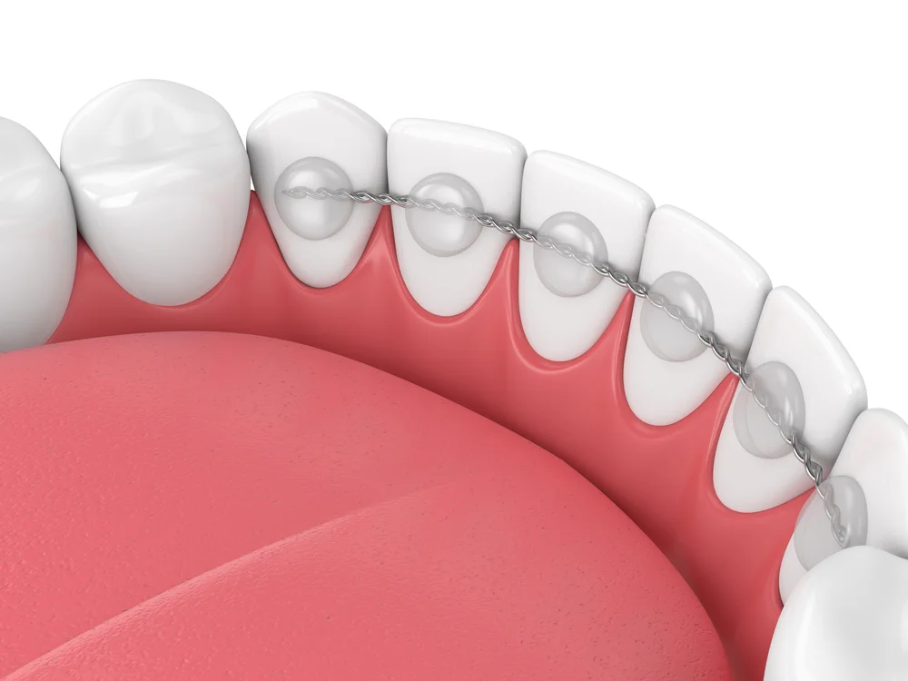 Fixed retainer wire bonded behind the lower front teeth on a dental model
