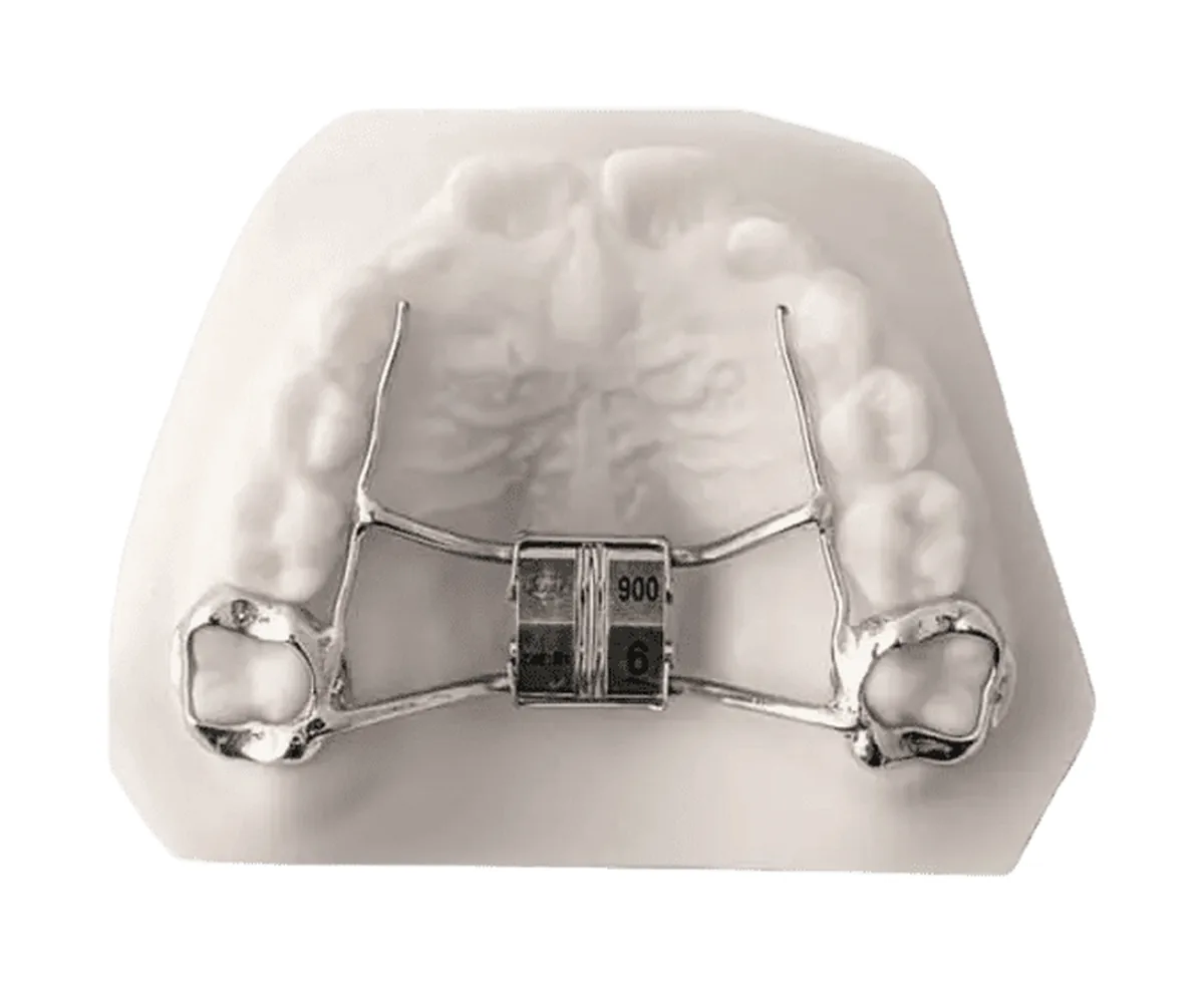 Leaf Expander spring-activated palate expander on a dental model at Ogden Orthodontics
