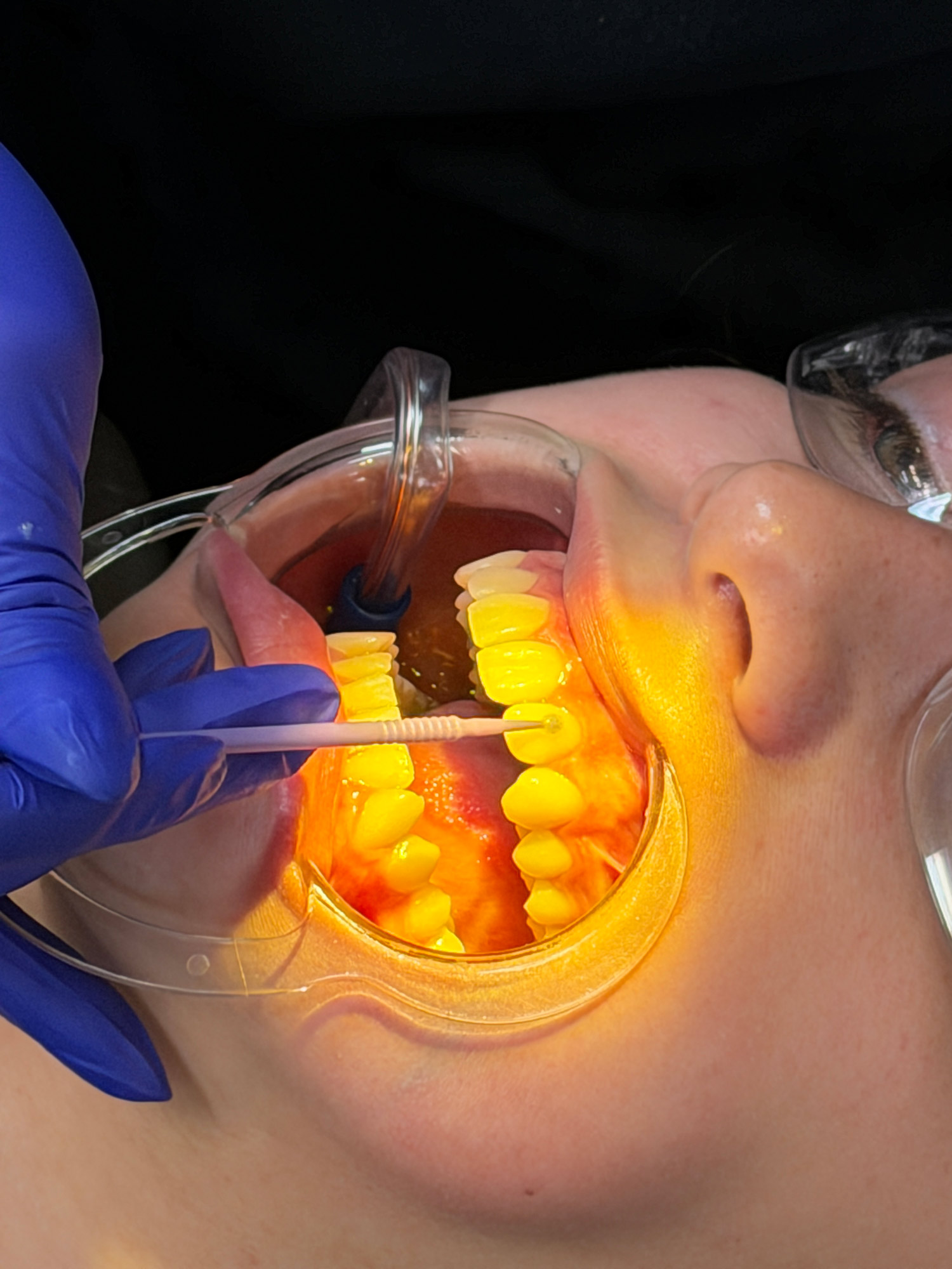 Attachment being bonded to a tooth before Invisalign treatment begins