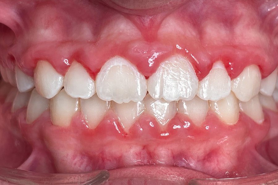 After: front teeth closing together with the open bite corrected