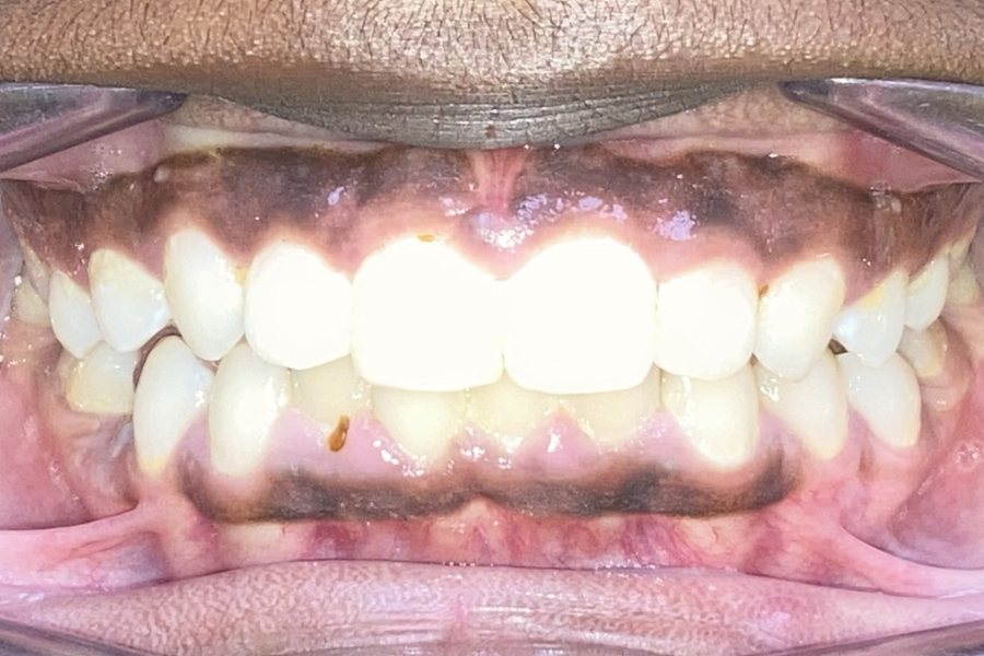 Before: deep bite with the upper teeth covering most of the lower teeth, and lower crowding
