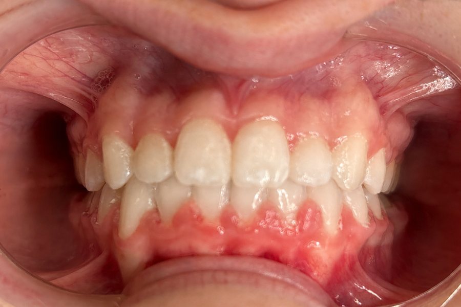 After: normal bite depth with the teeth lined up