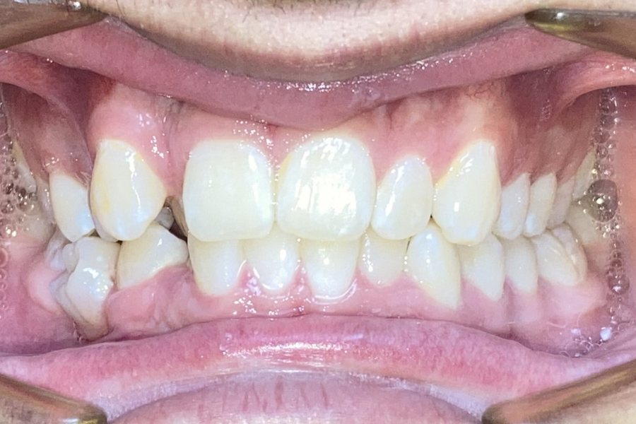 Before: crowding with one upper tooth trapped behind the lower teeth