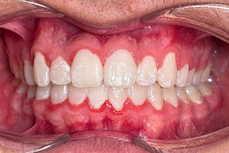 After: the crossbite corrected and both arches aligned