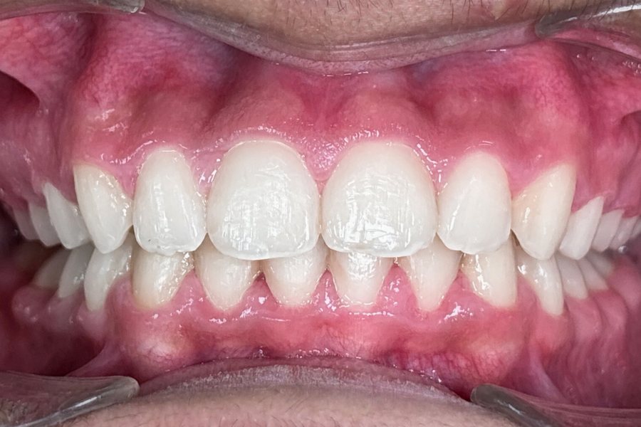 After: bite opened to a normal overlap with every tooth aligned