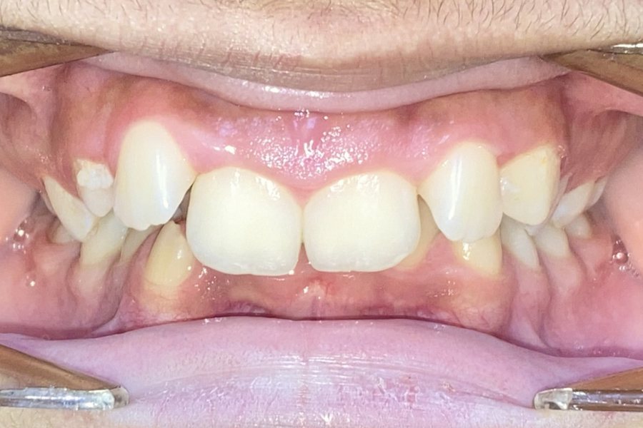 Before: severe deep bite hiding the lower teeth, with blocked-out canines