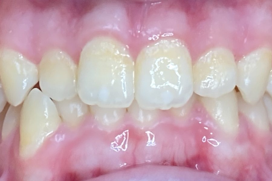 Before: deep bite with the upper front teeth overlapping the lower teeth too far