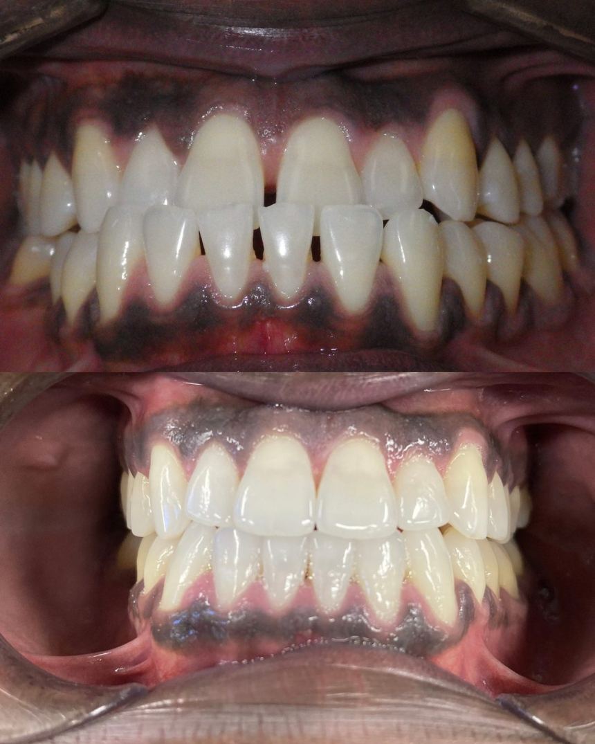 Before and after photos of a braces case at Ogden Orthodontics showing corrected crowding and bite