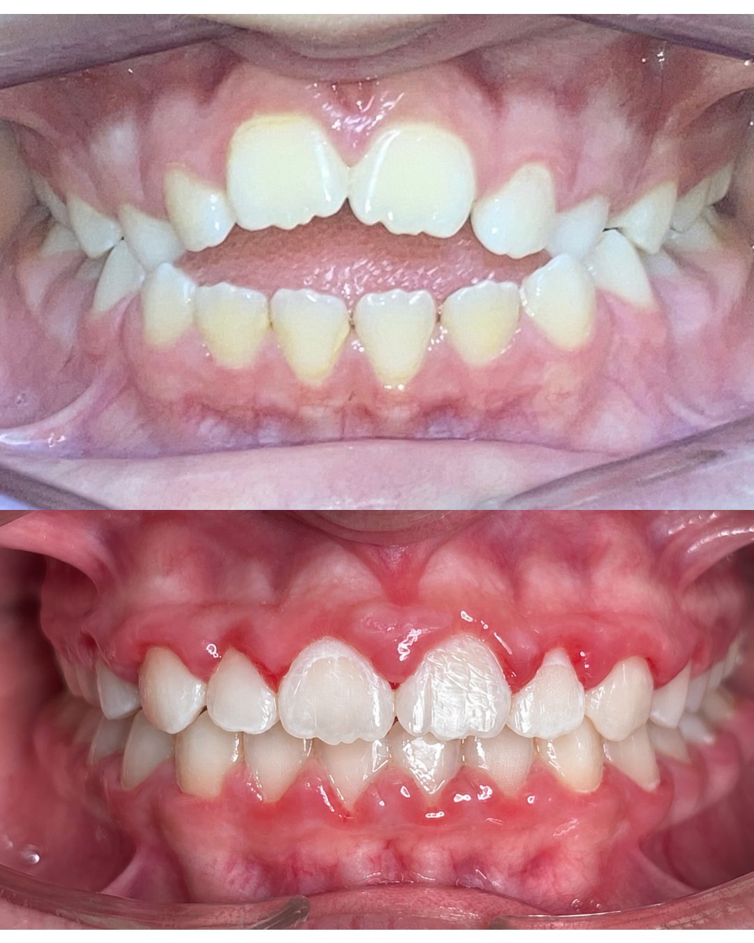 Before and after photos of an open bite corrected with braces by Dr. Robert Ogden at Ogden Orthodontics