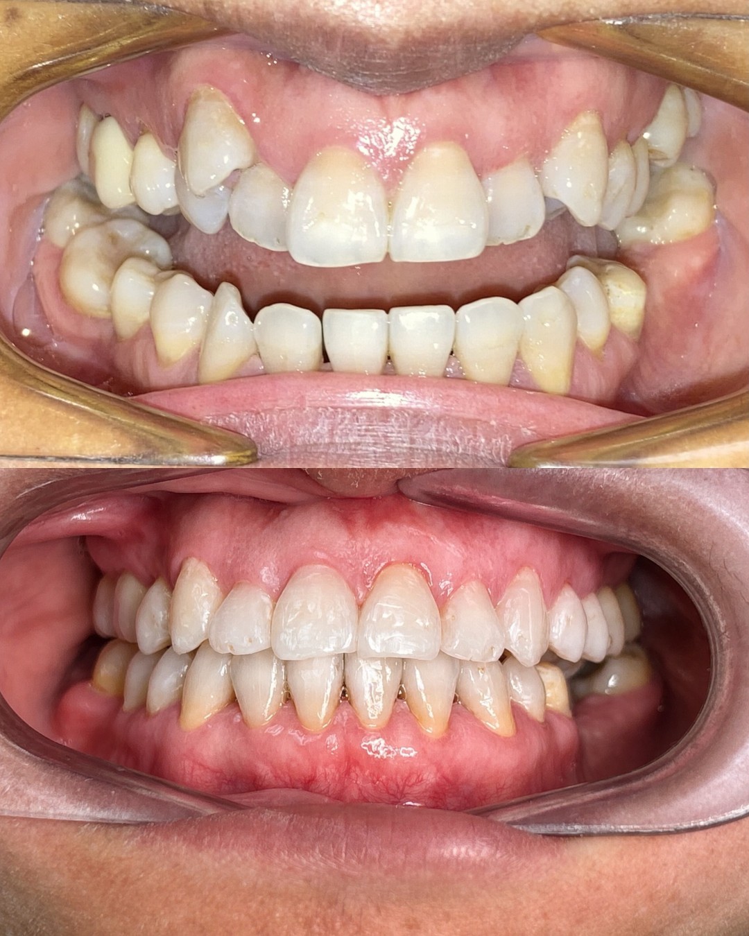 Before and after photos of crowded, rotated teeth straightened with braces