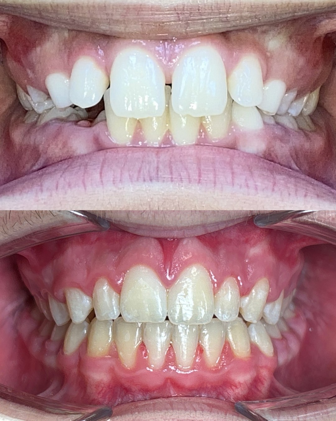 Before and after photos of a front tooth gap closed with braces