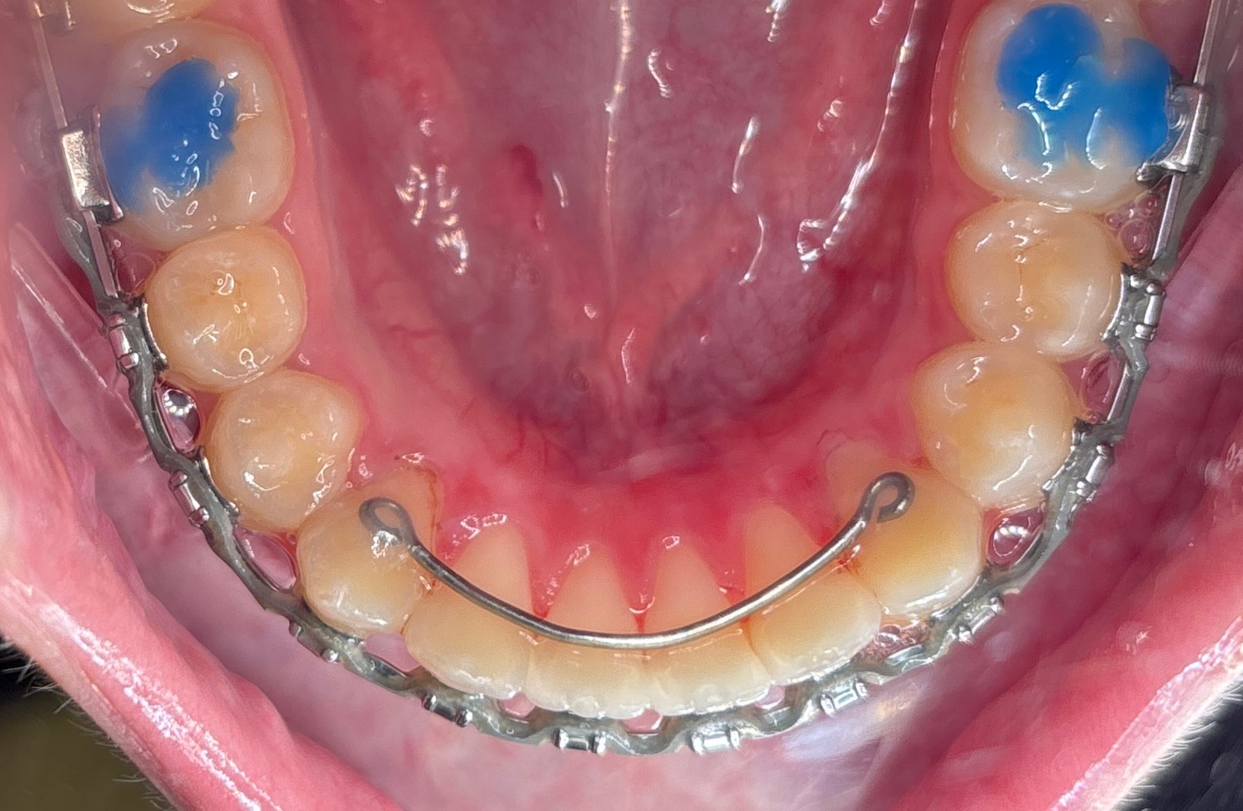 Fixed retainer wire behind the lower front teeth, bonded at set points rather than to every tooth, at Ogden Orthodontics