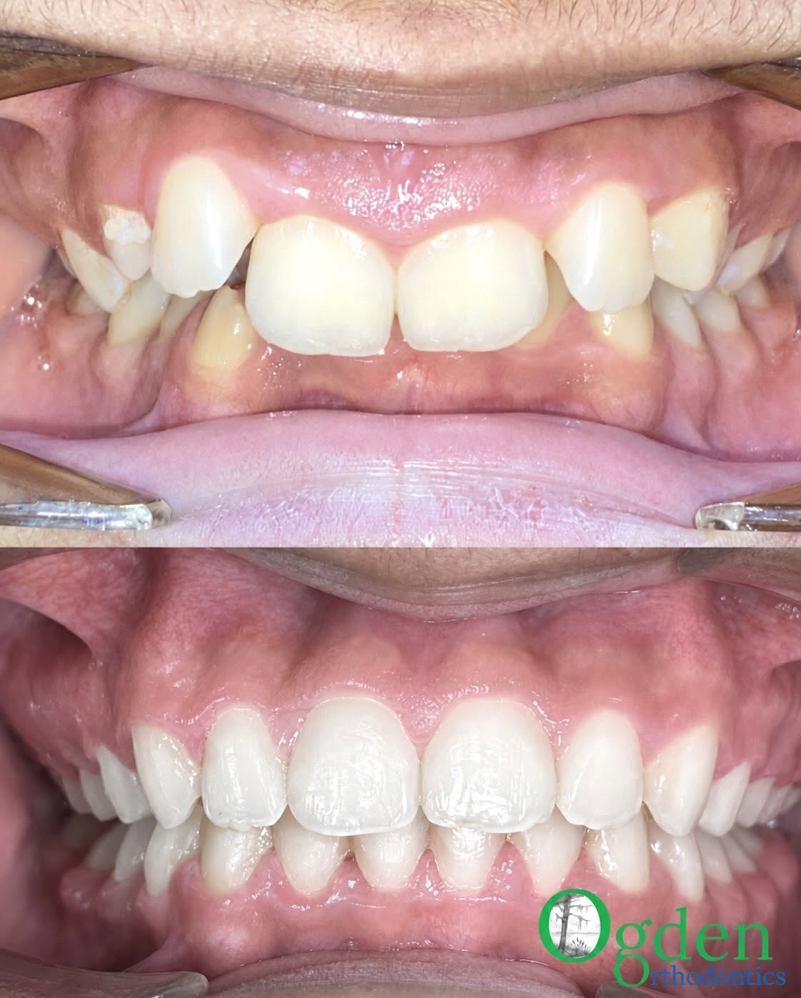 Before and after photos of crowded front teeth in a growing smile, treated at Ogden Orthodontics