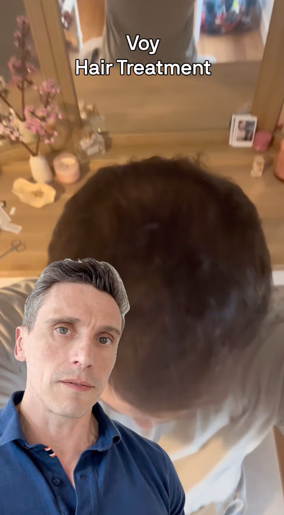 Voy Hair Loss