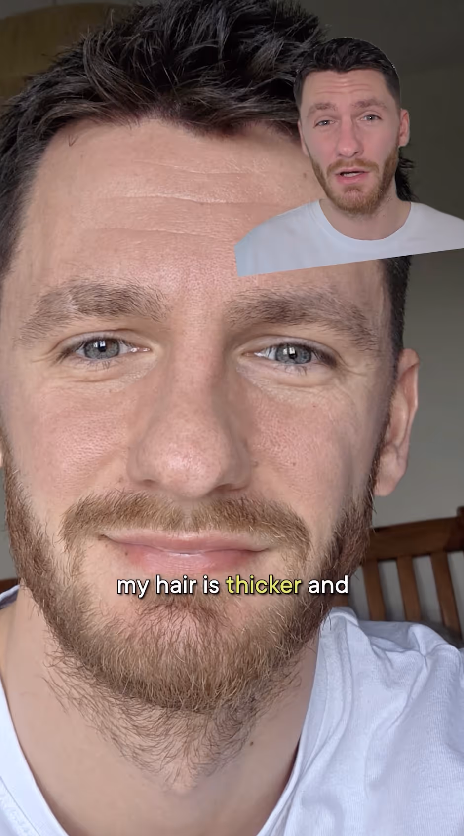 Voy Hair Loss