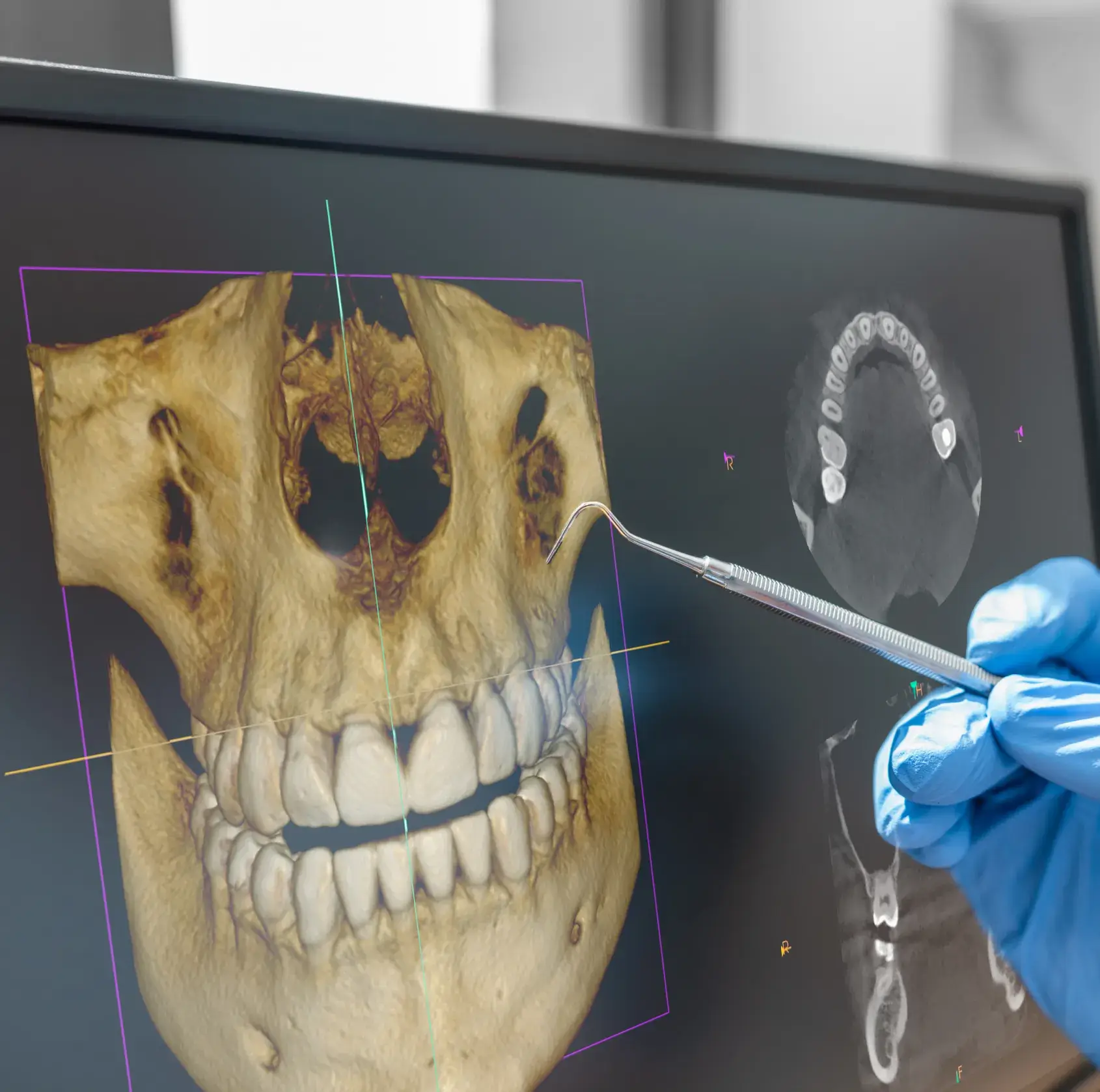 Dental professional wearing blue gloves pointing at 3D dental and jawbone scans on a computer screen with a dental explorer tool.