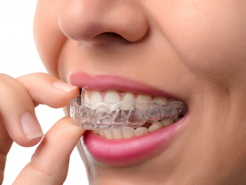 Discovering Invisalign: A Modern Solution to Orthodontics at Springfield Gentle Dental