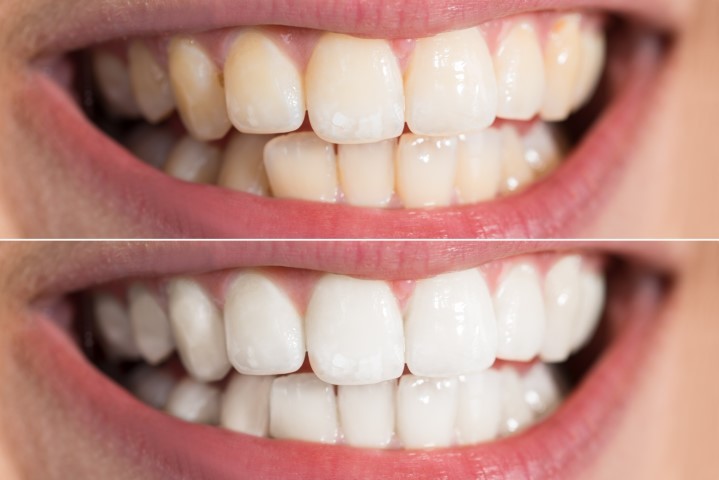 Brighten Your Smile with Professional Teeth Whitening