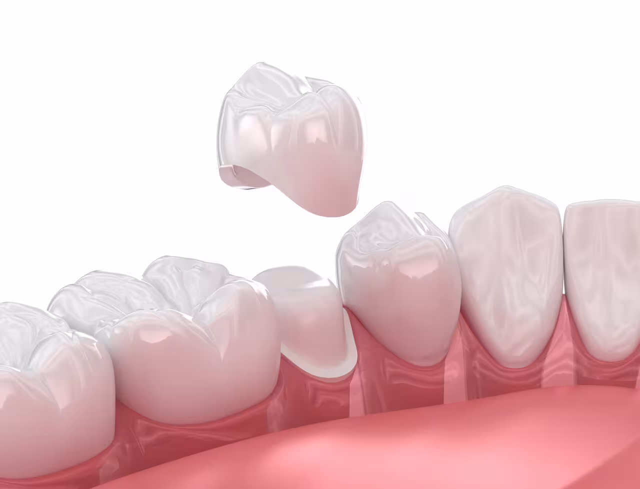 Dental Crowns in St. Petersburg, FL