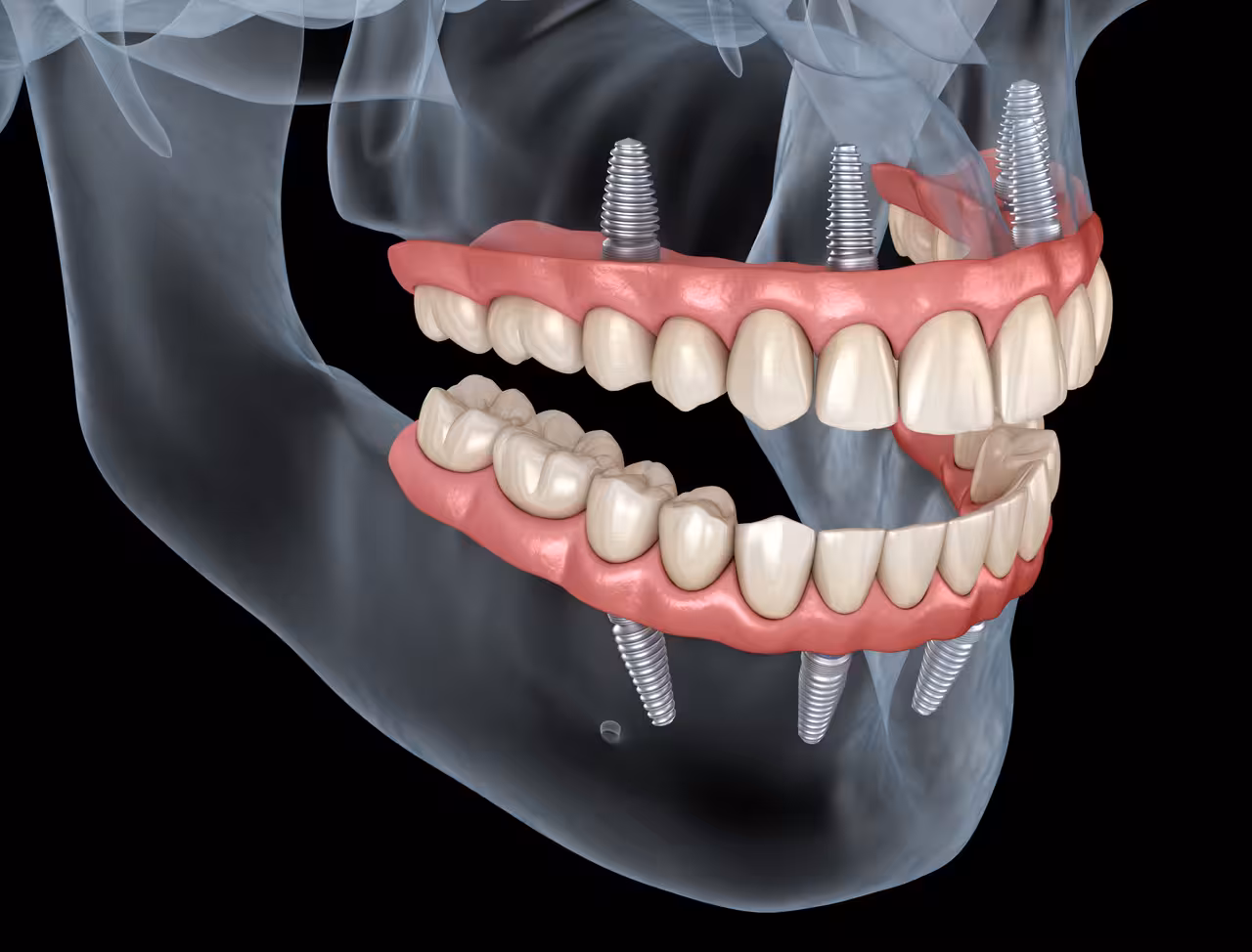 All-on-Four Dental Implants in St. Petersburg, FL
