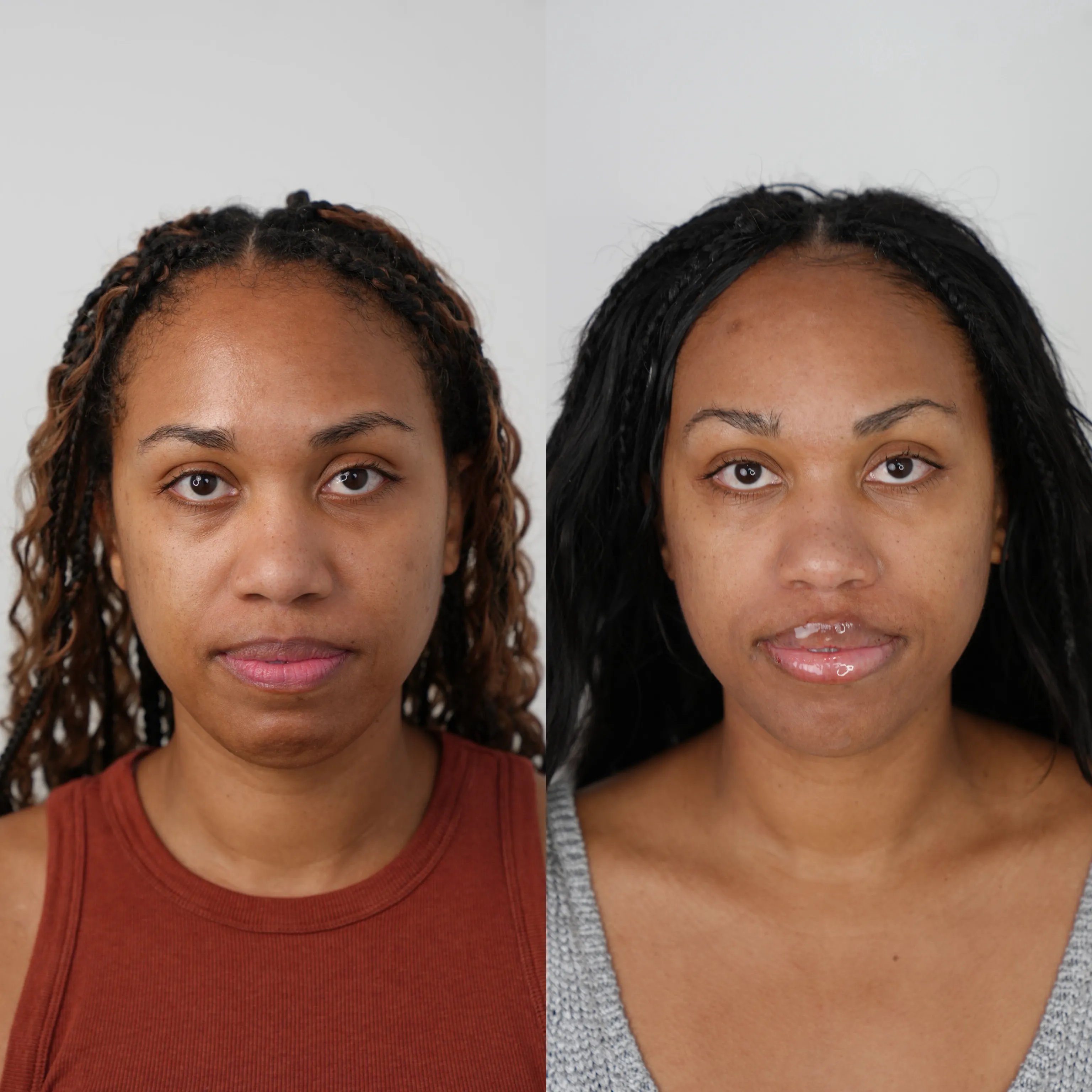 XERF before and after showing smoother, firmer, more radiant skin