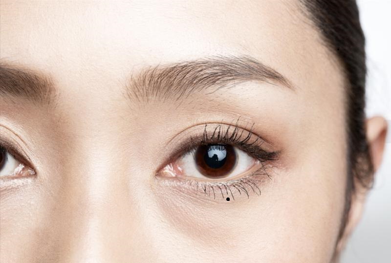 Giải mã tất tật bí mật về nốt ruồi ở mắt