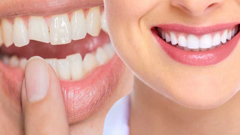How Long Does it Take to see Results for Cosmetic Dentistry
