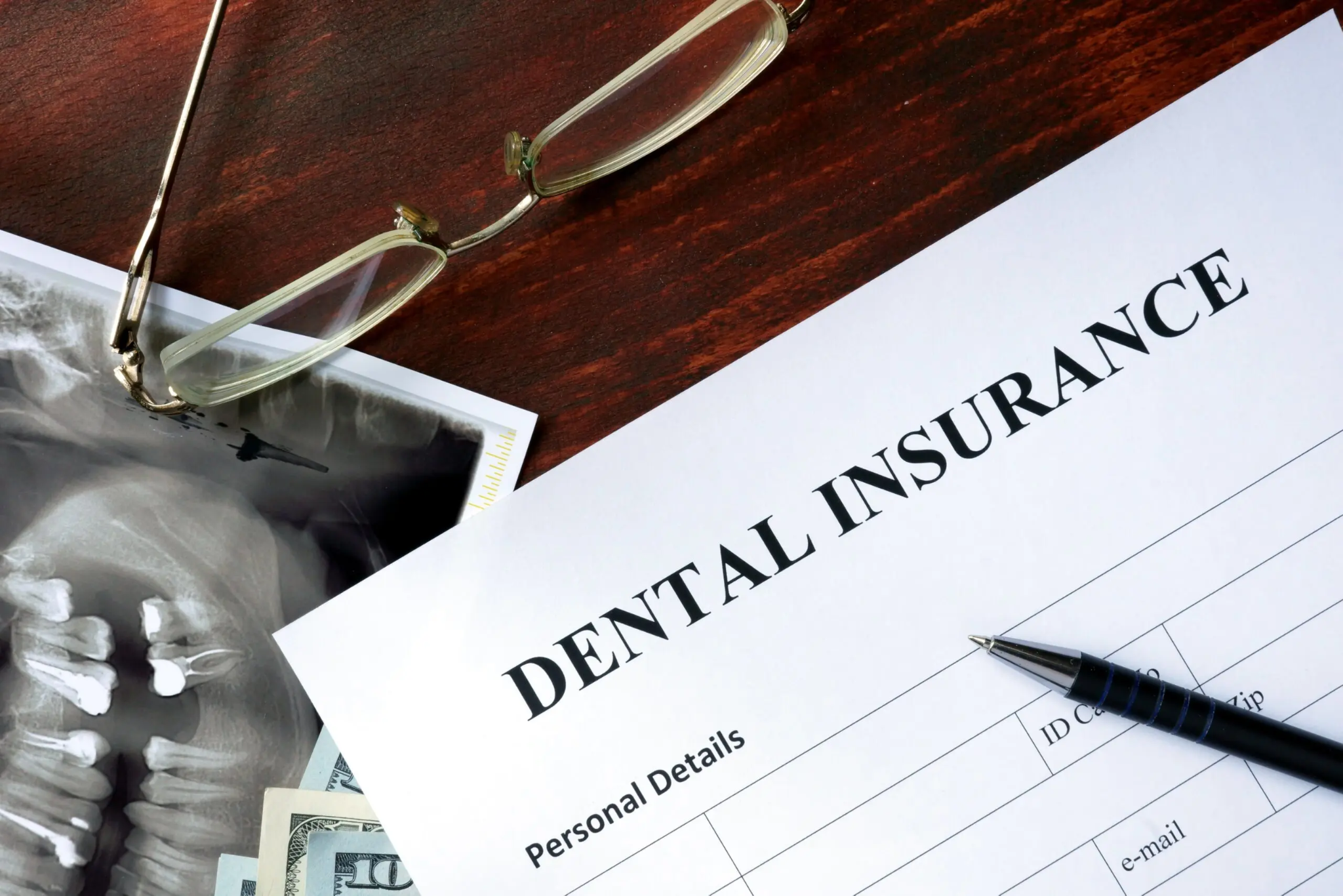 Dental insurance covers a portion of the cost of dental implants