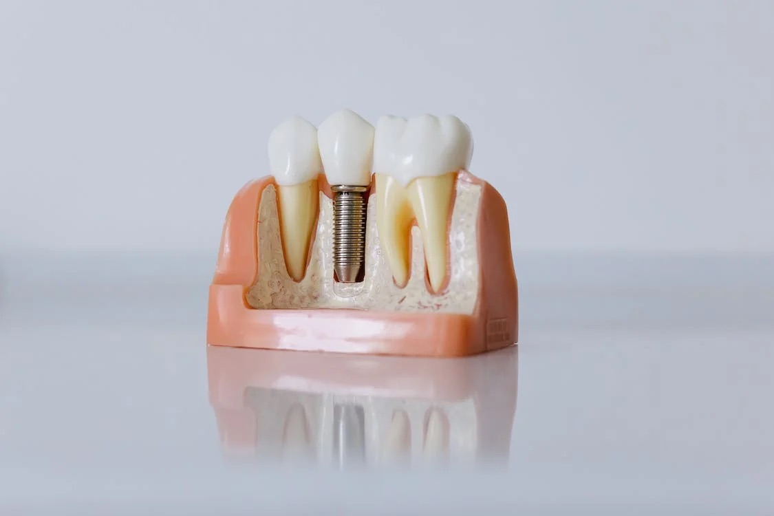 Some costs associated with dental implants will not be covered by insurance
