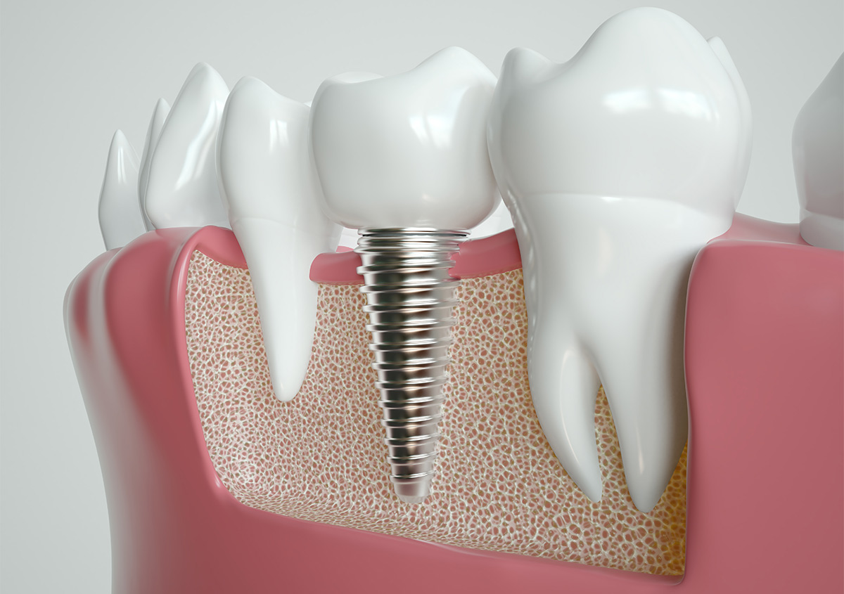 Which Parts of Dental Implant Treatment Are Usually Covered?